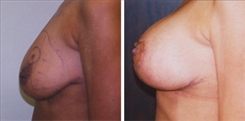 Breast Augmentation Patient Before & After Photo 1