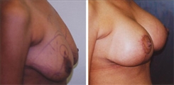 Breast Augmentation Patient Before & After Photo 1