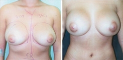 Breast Augmentation Patient Before & After Photo 1