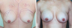 Breast Augmentation Patient Before & After Photo 1