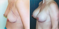 Breast Augmentation Patient Before & After Photo 1