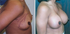 Breast Augmentation Patient Before & After Photo 1