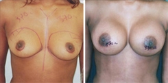 Breast Augmentation Patient Before & After Photo 1