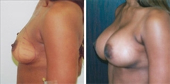 Breast Augmentation Patient Before & After Photo 1