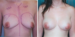 Breast Augmentation Patient Before & After Photo 1