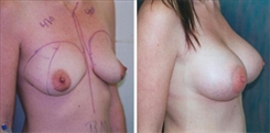 Breast Augmentation Patient Before & After Photo 1