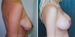 Breast Augmentation Patient Before & After Photo 1