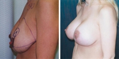 Breast Augmentation Patient Before & After Photo 1