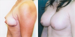 Breast Augmentation Patient Before & After Photo 1