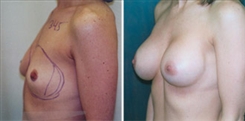 Breast Augmentation Patient Before & After Photo 1