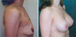 Breast Augmentation Patient Before & After Photo 1