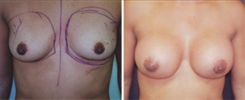 Breast Augmentation Patient Before & After Photo 1