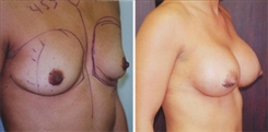 Breast Augmentation Patient Before & After Photo 1