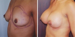 Breast Augmentation Patient Before & After Photo 1