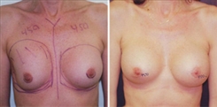 Breast Augmentation Patient Before & After Photo 1