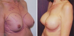 Breast Augmentation Patient Before & After Photo 1