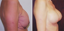 Breast Augmentation Patient Before & After Photo 1