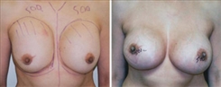 Breast Augmentation Patient Before & After Photo 1