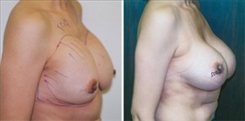 Breast Augmentation Patient Before & After Photo 1