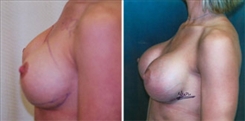 Breast Augmentation Patient Before & After Photo 1