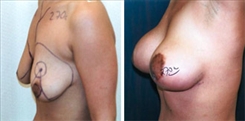 Breast Augmentation Patient Before & After Photo 1