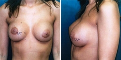 Breast Augmentation Patient Before & After Photo 1