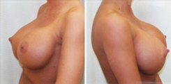 Breast Augmentation Patient Before & After Photo 1