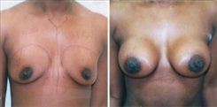 Breast Augmentation Patient Before & After Photo 1