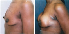 Breast Augmentation Patient Before & After Photo 1