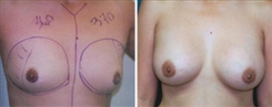 Breast Augmentation Patient Before & After Photo 1