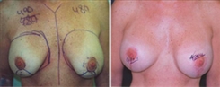 Breast Augmentation Patient Before & After Photo 1