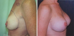 Breast Augmentation Patient Before & After Photo 1