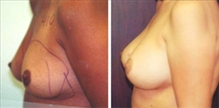 Breast Augmentation Patient Before & After Photo 1