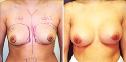 Breast Augmentation Patient Before & After Photo 1