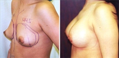 Breast Augmentation Patient Before & After Photo 1