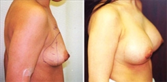 Breast Augmentation Patient Before & After Photo 1