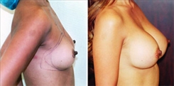 Breast Augmentation Patient Before & After Photo 1