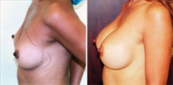 Breast Augmentation Patient Before & After Photo 1