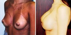 Breast Augmentation Patient Before & After Photo 1