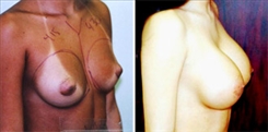 Breast Augmentation Patient Before & After Photo 1