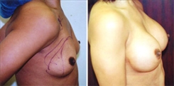 Breast Augmentation Patient Before & After Photo 1