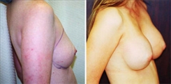 Breast Augmentation Patient Before & After Photo 1