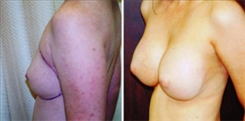 Breast Augmentation Patient Before & After Photo 1