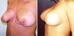 Breast Augmentation Patient Before & After Photo 1