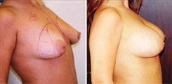 Breast Augmentation Patient Before & After Photo 1