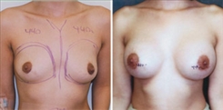 Breast Augmentation Patient Before & After Photo 1