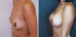 Breast Augmentation Patient Before & After Photo 1