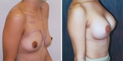 Breast Augmentation Patient Before & After Photo 1