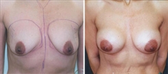 Breast Augmentation Patient Before & After Photo 1