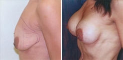 Breast Augmentation Patient Before & After Photo 1